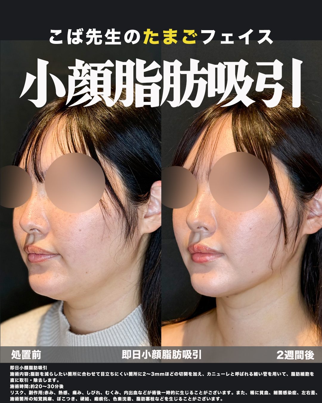小顔脂肪吸引（フェイスライン・ジョールファット・エラ下・顎下）の症例。処置前と術後を斜めから並べた比較写真。