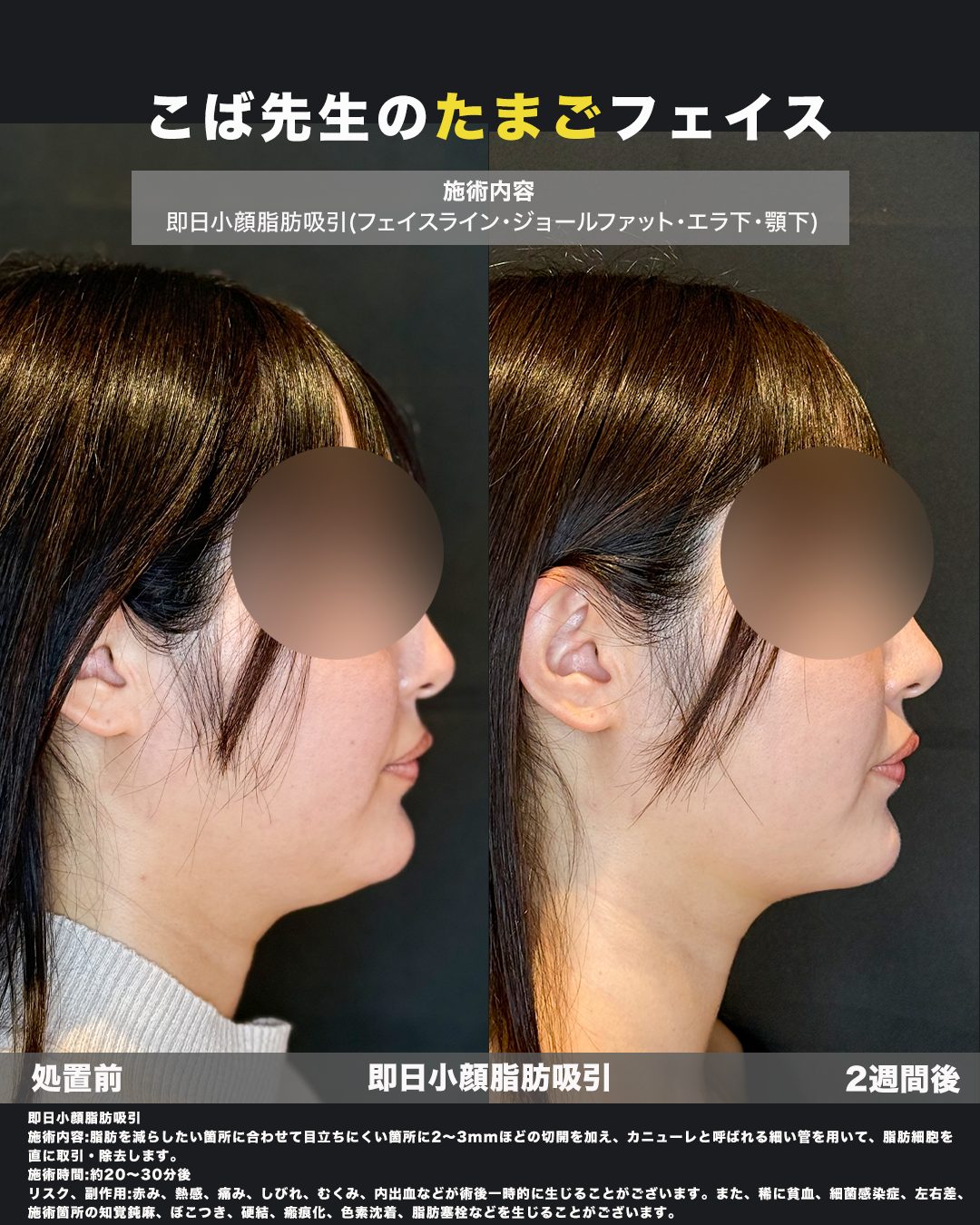 小顔脂肪吸引（フェイスライン・ジョールファット・エラ下・顎下）の症例。処置前と術後を横（側面）から並べた比較写真。