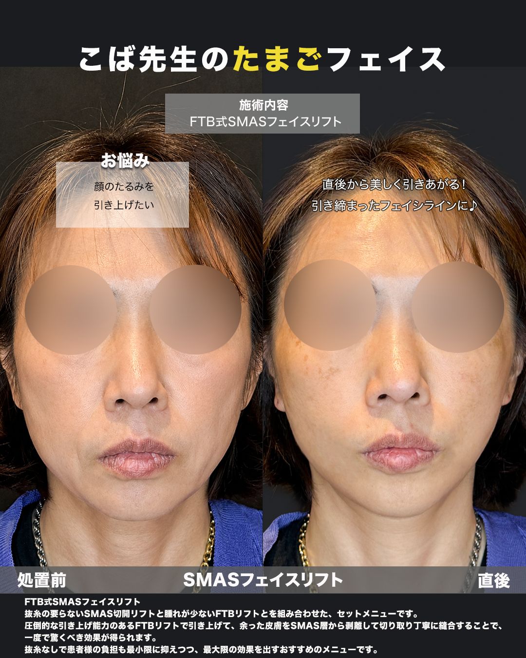 FTB式SMASフェイスリフトの症例。処置前と術後を正面から並べた比較写真。