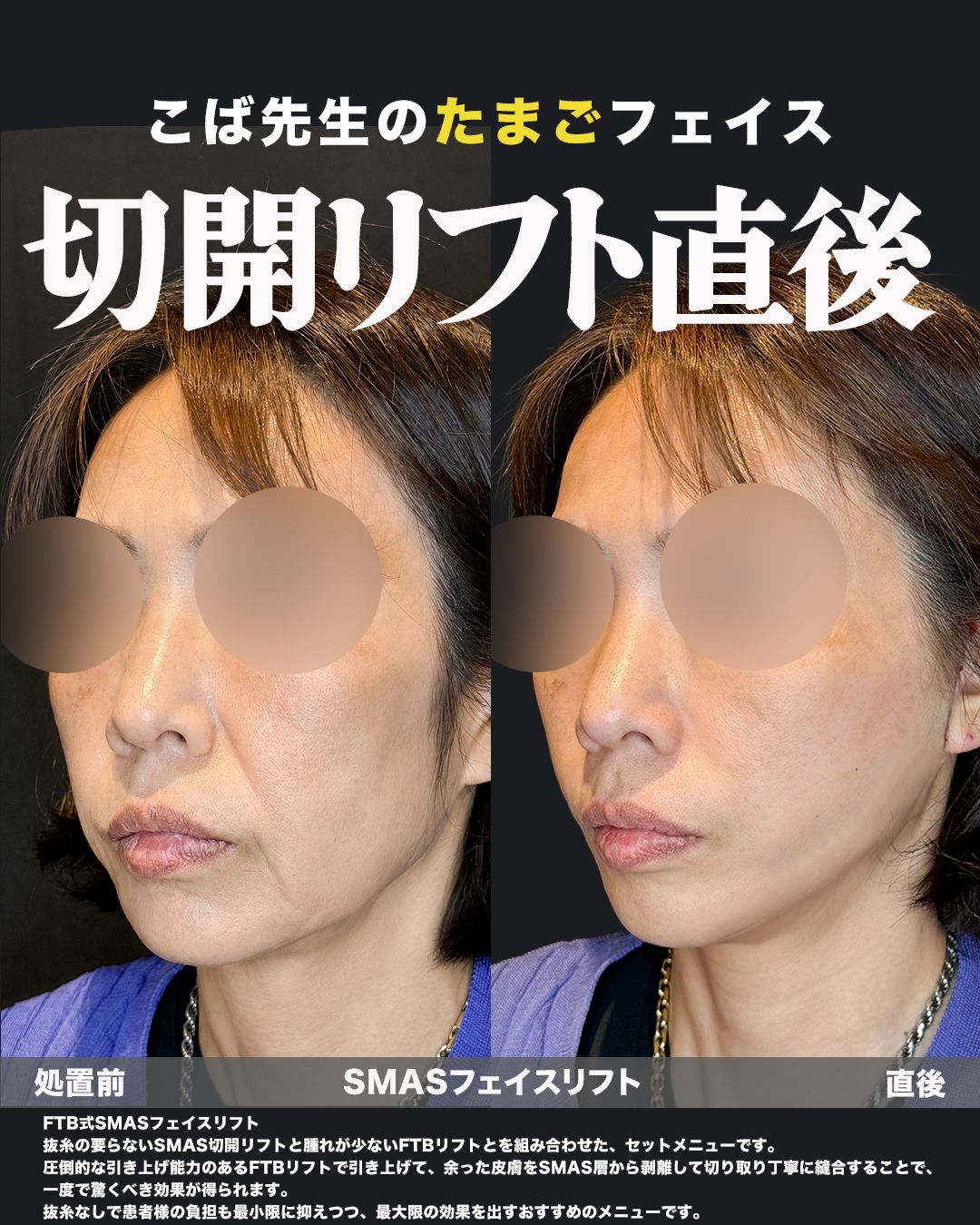 FTB式SMASフェイスリフトの症例。処置前と術後を斜めから並べた比較写真。