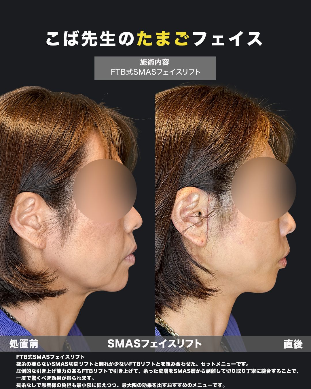 FTB式SMASフェイスリフトの症例。処置前と術後を横（側面）から並べた比較写真。