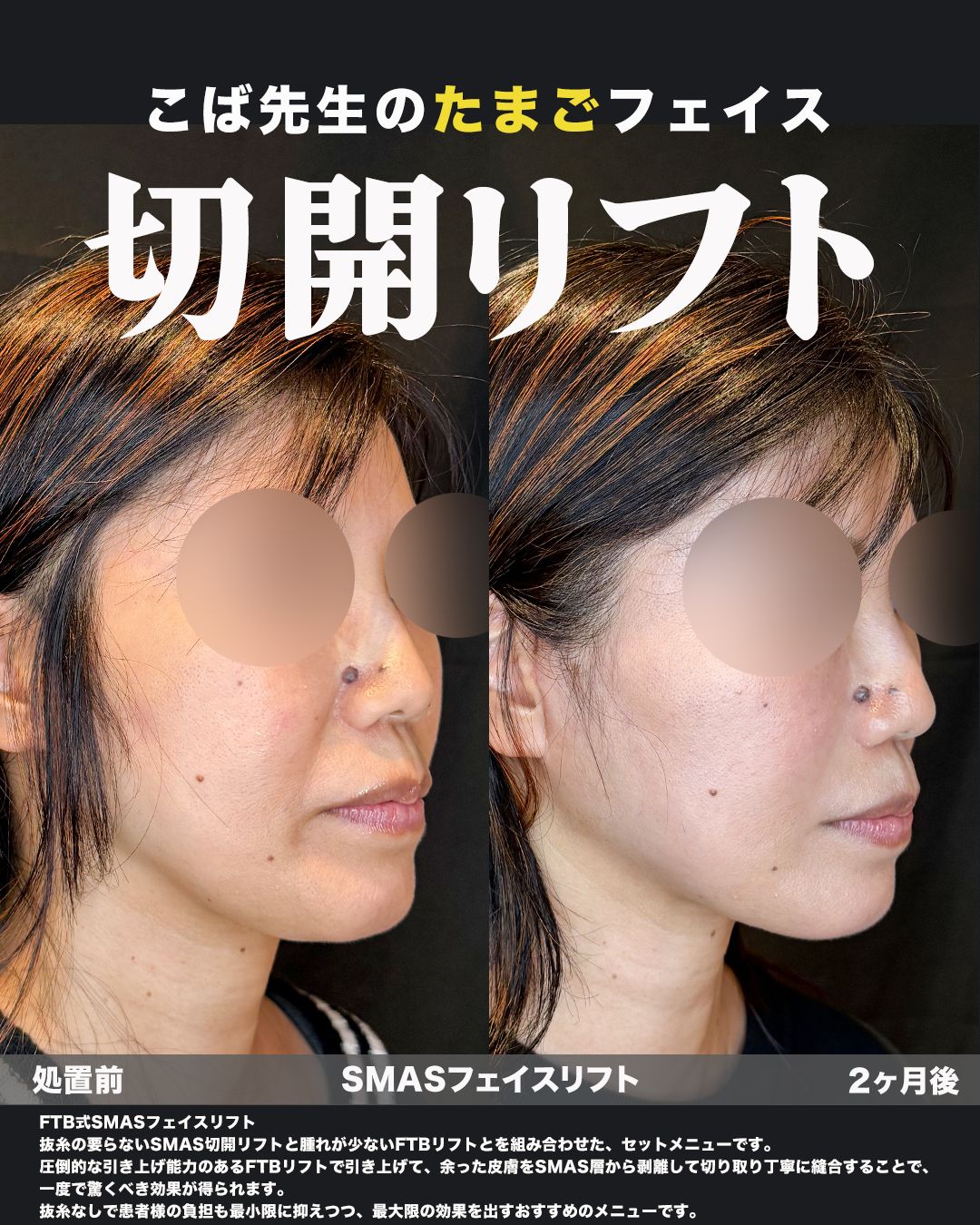 FTB式SMASフェイスリフトの症例。処置前と術後を斜めから並べた比較写真。