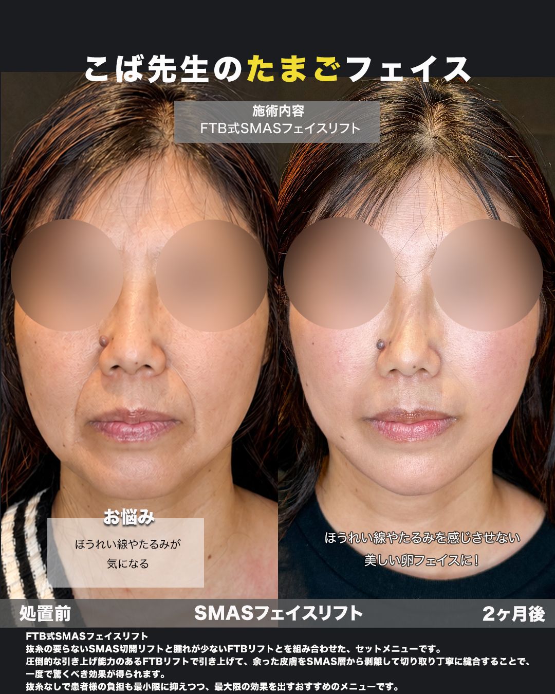 FTB式SMASフェイスリフトの症例。処置前と術後を斜めから並べた比較写真。