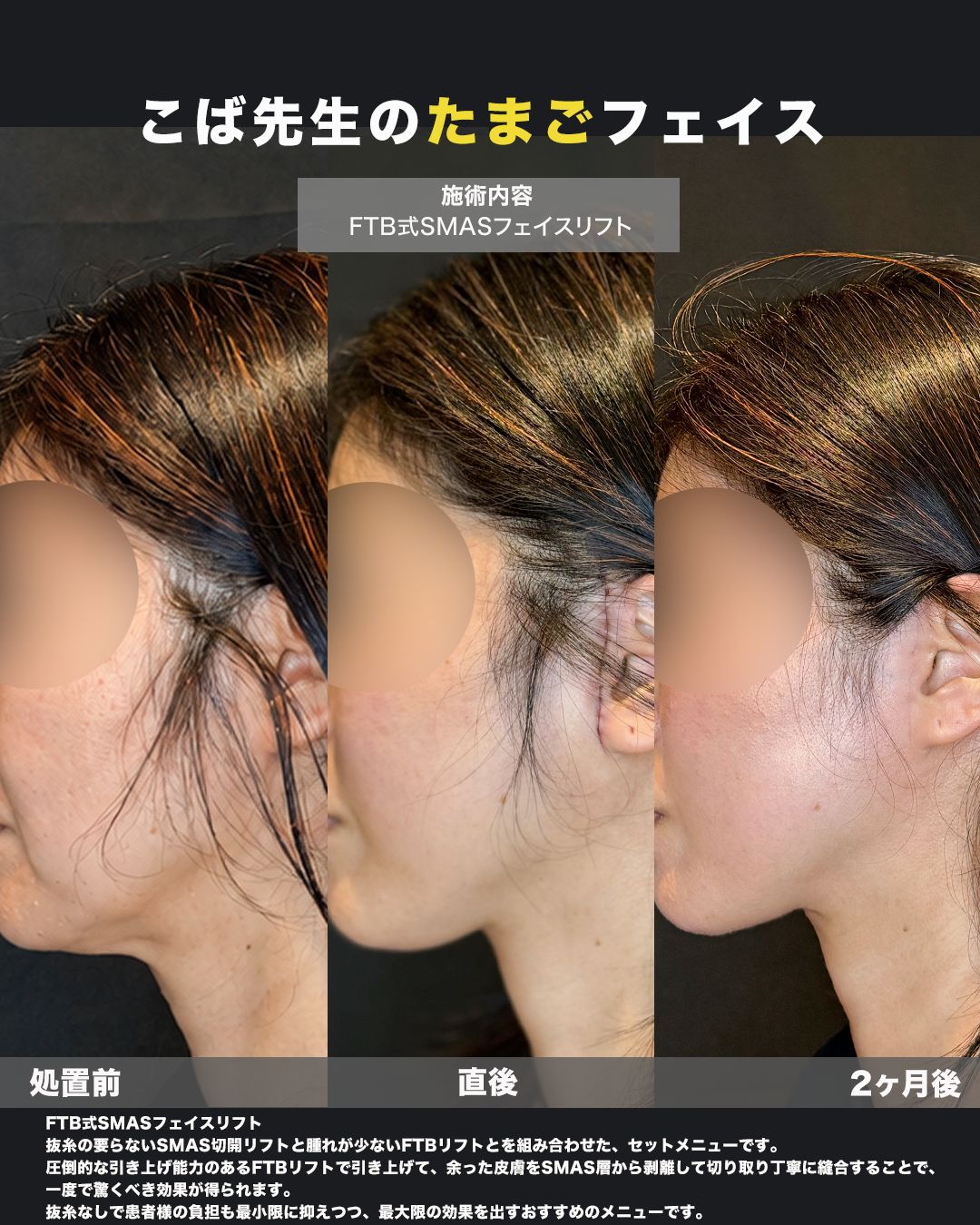 FTB式SMASフェイスリフトの症例。耳周りの切開部（傷跡）の状態を撮影した写真。