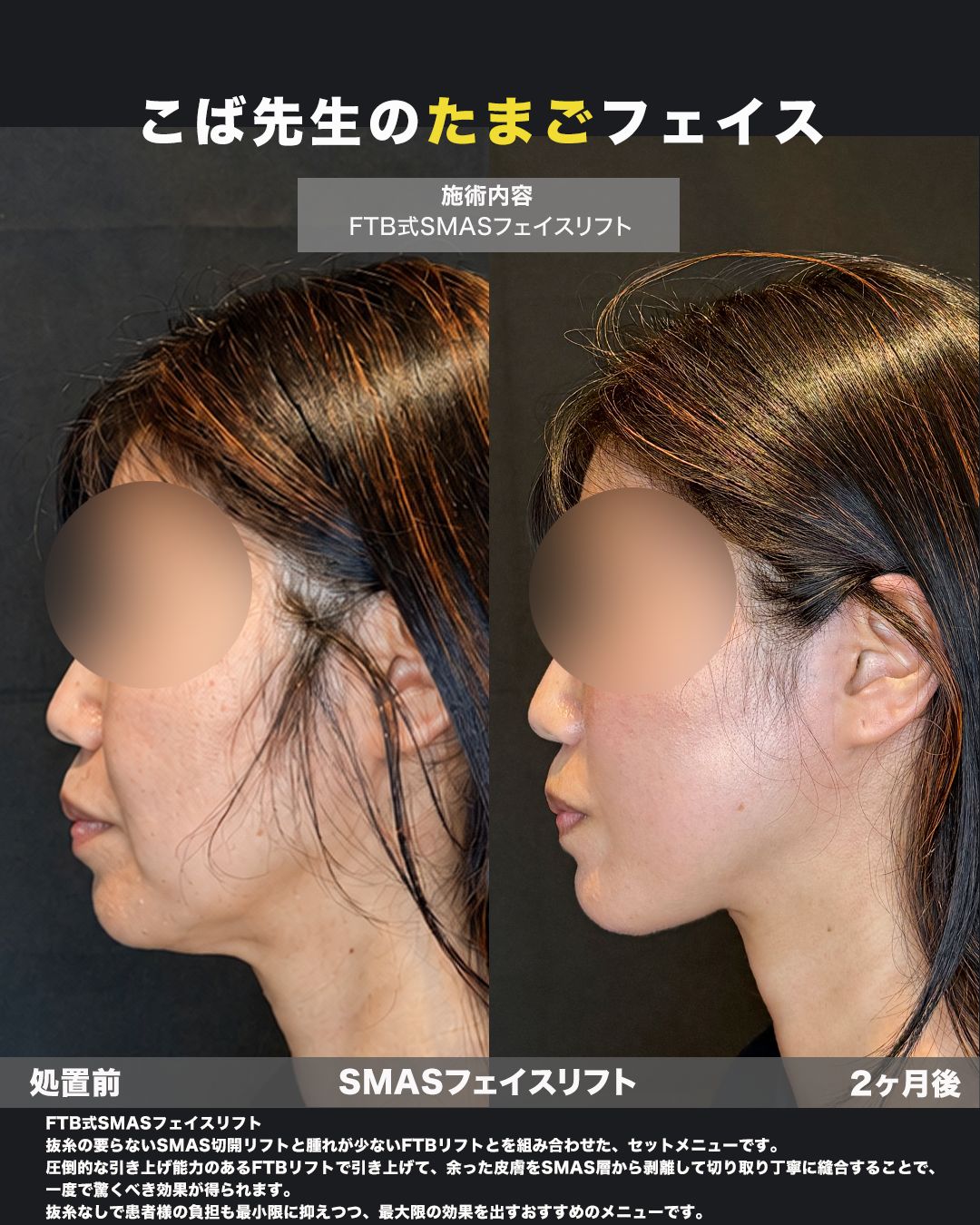 FTB式SMASフェイスリフトの症例。処置前と術後を横（側面）から並べた比較写真。