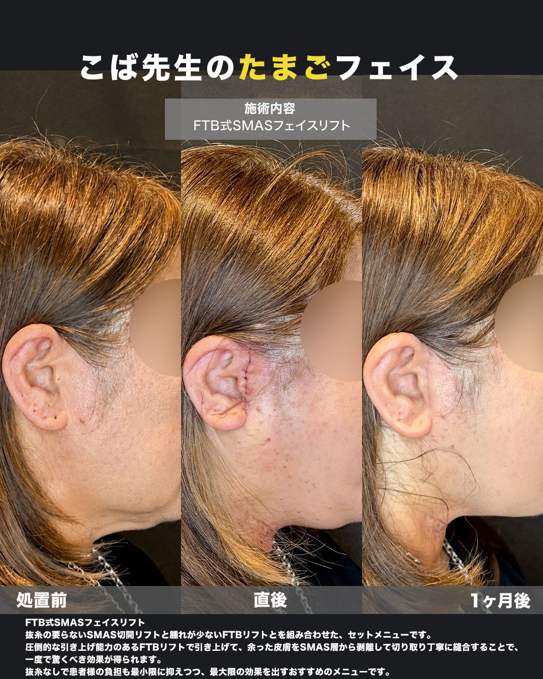 FTB式SMASフェイスリフトの症例。処置前から術後までの経過を並べた比較写真。