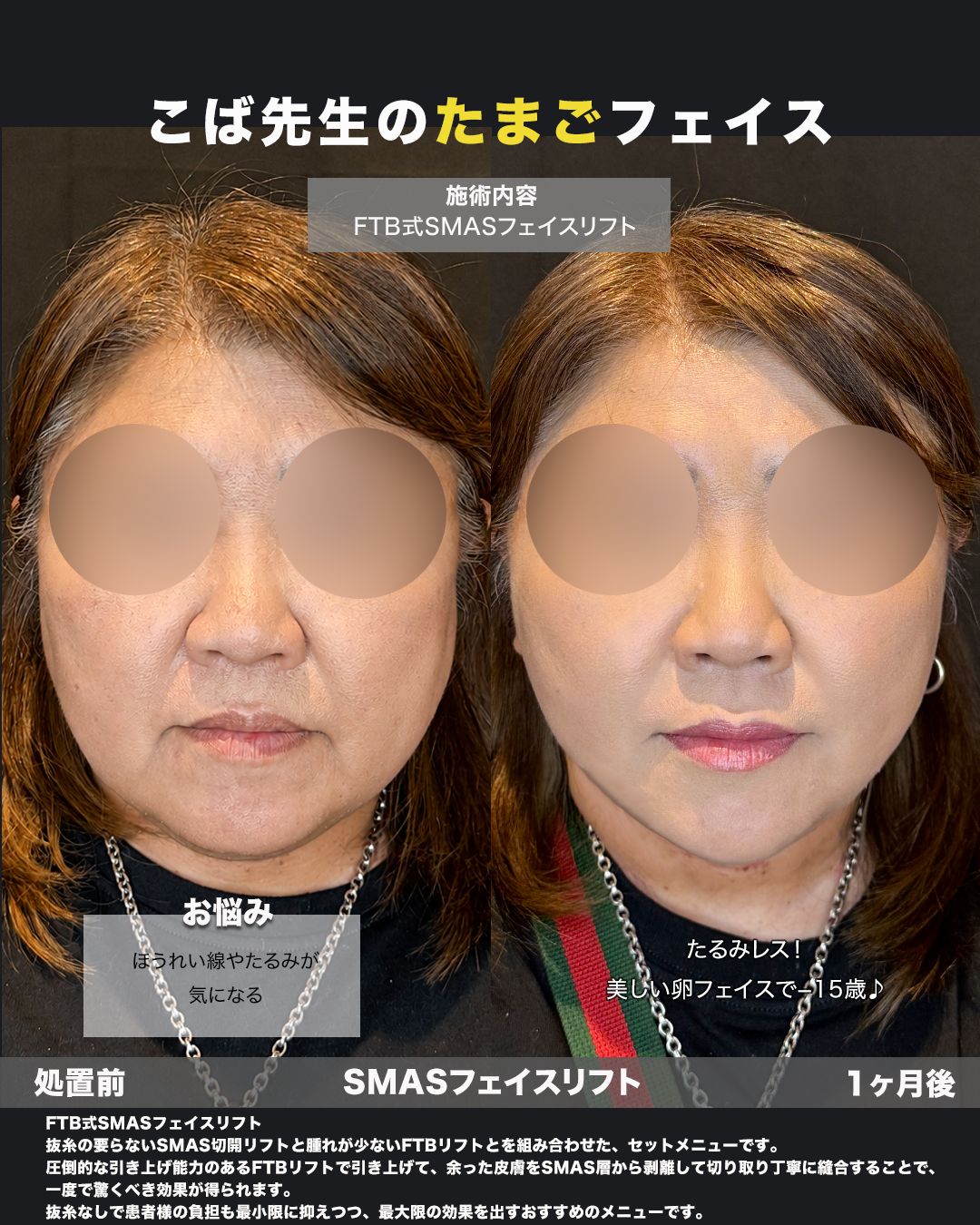 FTB式SMASフェイスリフトの症例。処置前と術後を正面から並べた比較写真。