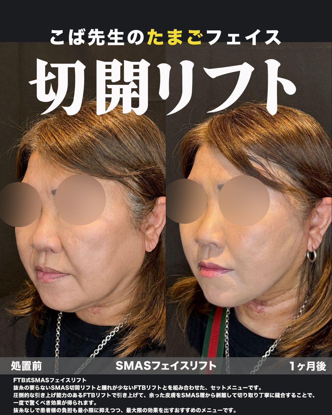 FTB式SMASフェイスリフトの症例。処置前と術後を斜めから並べた比較写真。