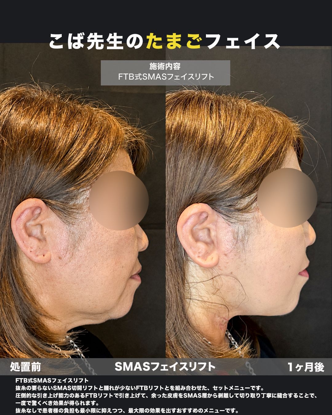 FTB式SMASフェイスリフトの症例。処置前と術後を横（側面）から並べた比較写真。