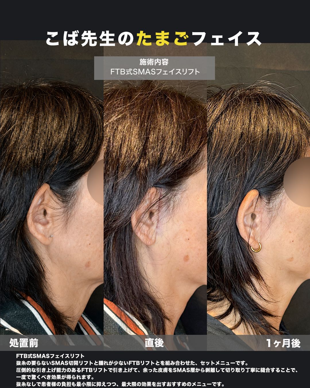 FTB式SMASフェイスリフトの症例。処置前と術後を斜めから並べた比較写真。