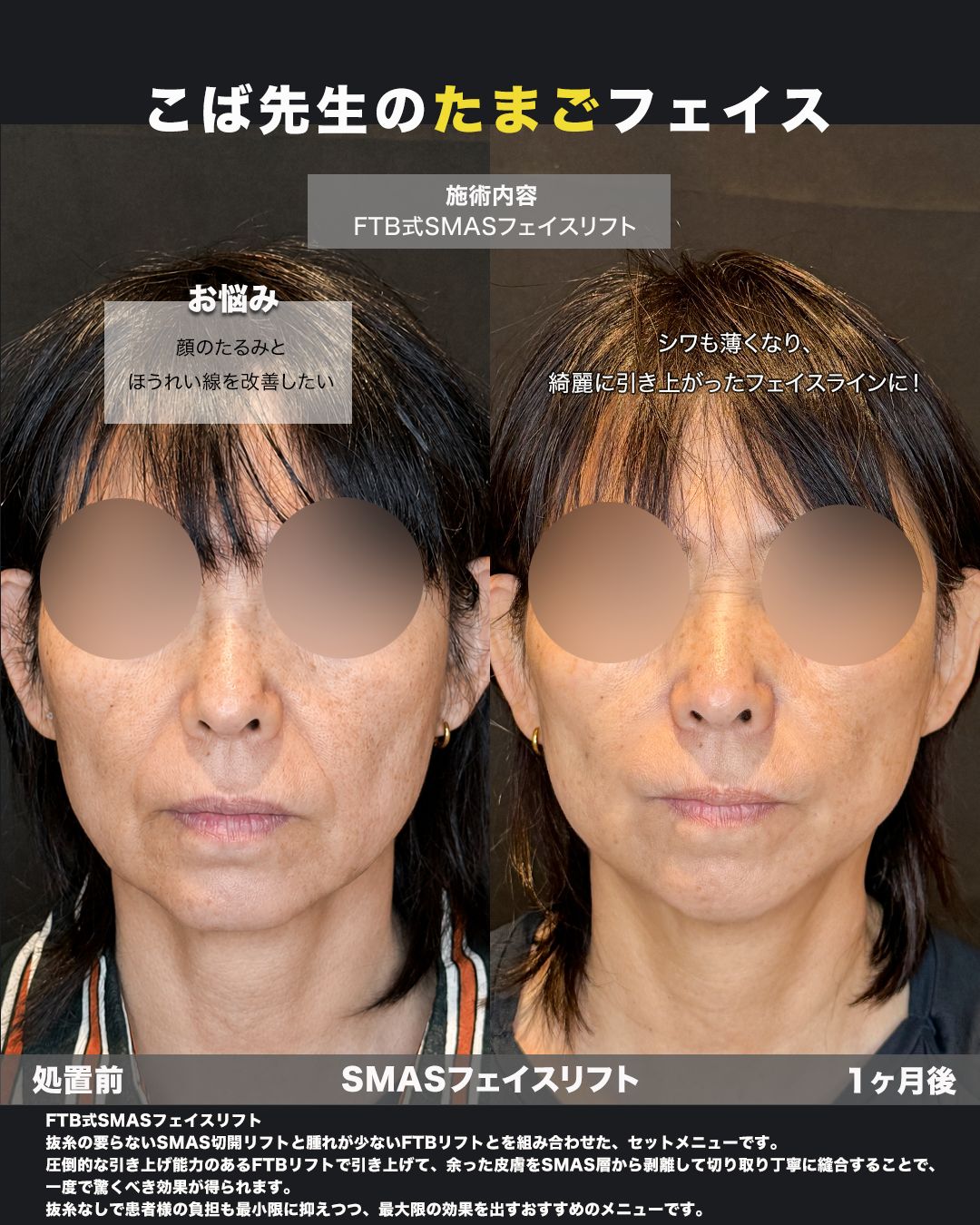 FTB式SMASフェイスリフトの症例。処置前と術後を正面から並べた比較写真。