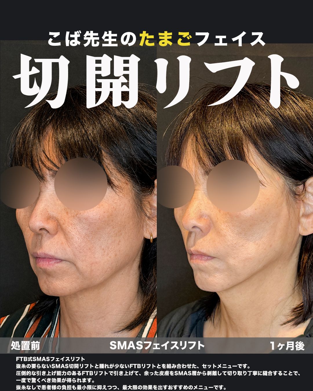 FTB式SMASフェイスリフトの症例。処置前と術後を斜めから並べた比較写真。
