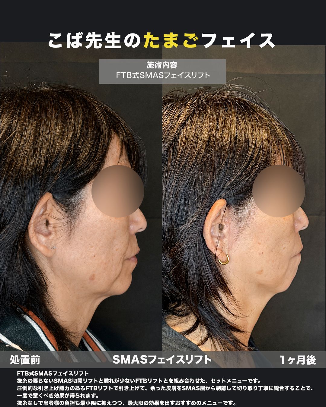 FTB式SMASフェイスリフトの症例。処置前と術後を横（側面）から並べた比較写真。