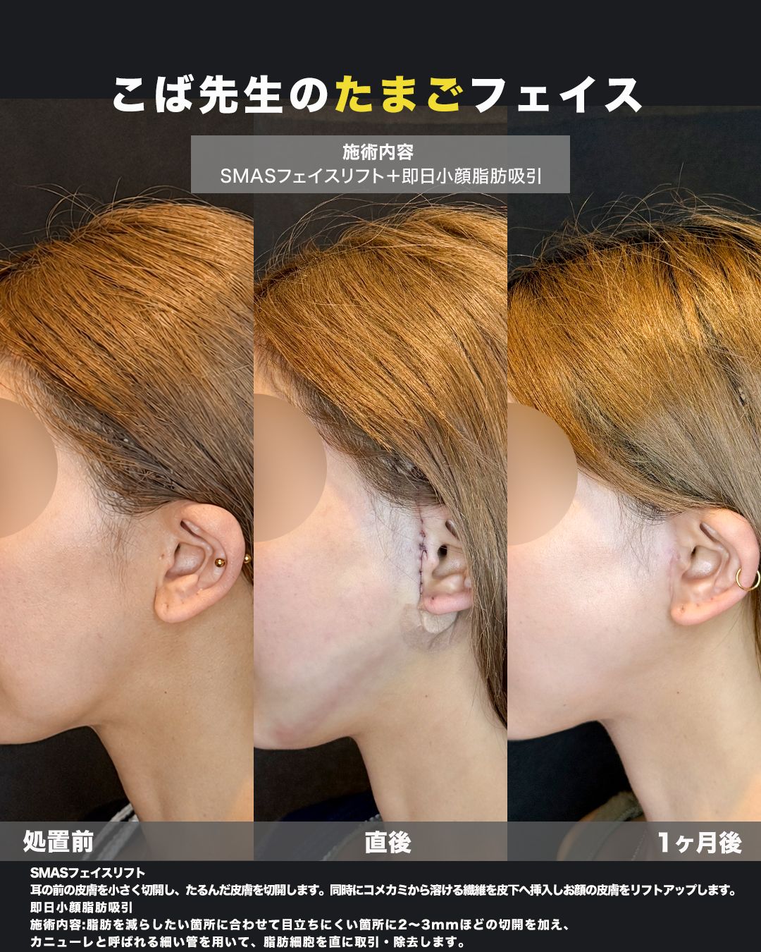 SMASフェイスリフト＋即日小顔脂肪吸引の症例。処置前から術後までの経過を並べた比較写真。