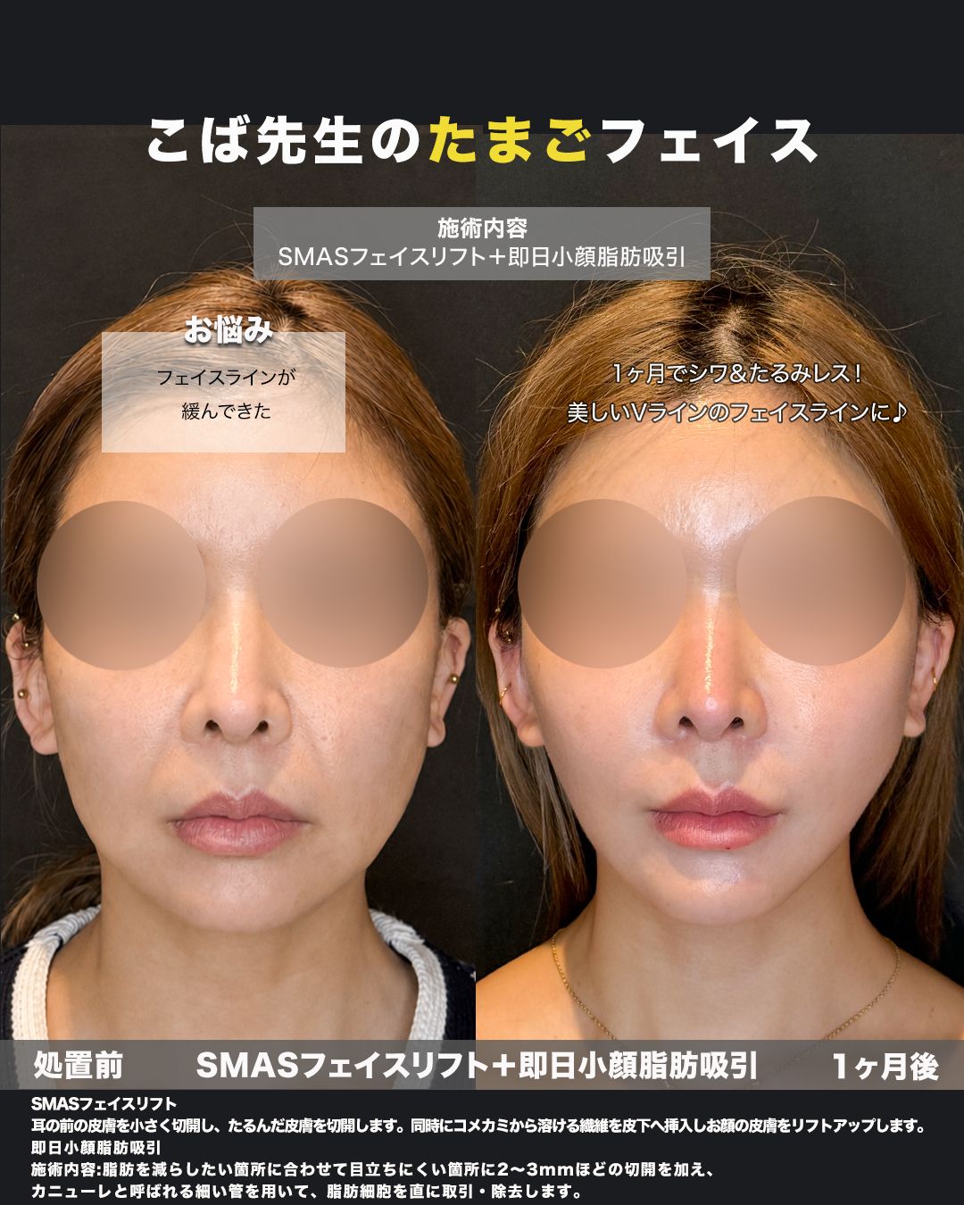 SMASフェイスリフト＋即日小顔脂肪吸引の症例。処置前と術後を正面から並べた比較写真。