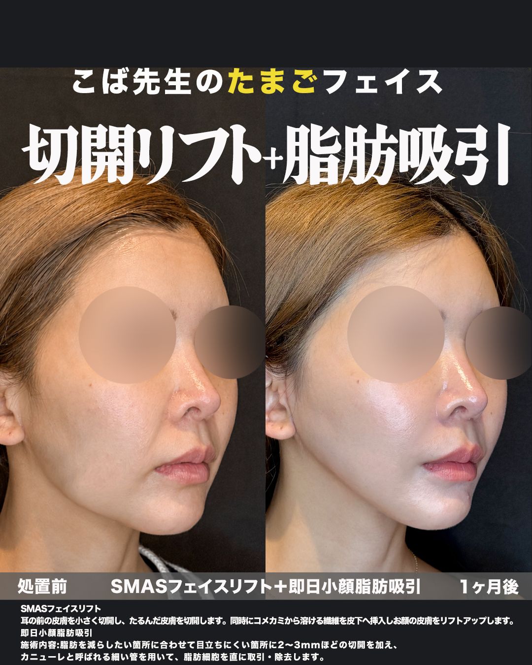SMASフェイスリフト＋即日小顔脂肪吸引の症例。処置前と術後を斜めから並べた比較写真。