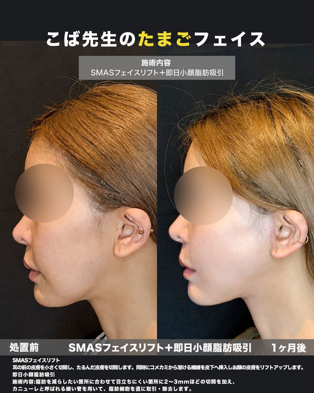 SMASフェイスリフト＋即日小顔脂肪吸引の症例。処置前と術後を横（側面）から並べた比較写真。